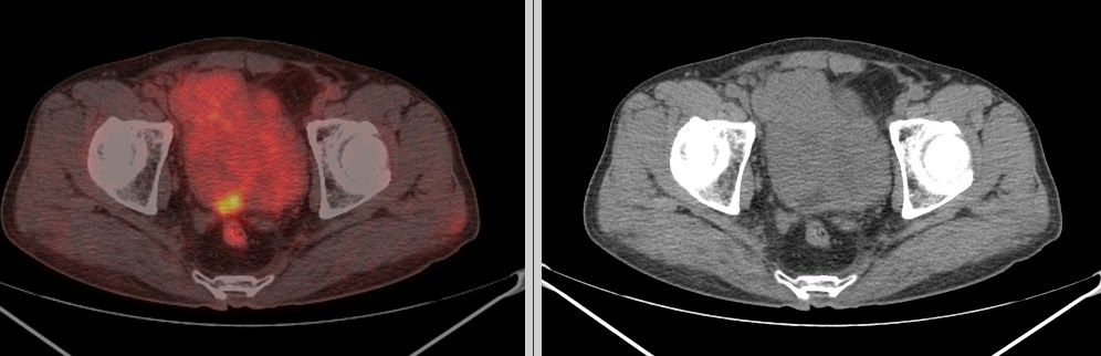 pet ct in prostate carcinoma