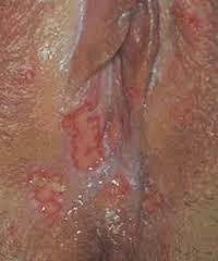Penyakit Herpes Vagina