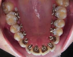 Niềng răng hàm dưới có đau không?