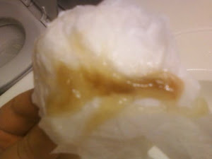 Foto Keluar Lendir Lengket Dari Vagina Disertai Rasa Nyeri Di Perut Bagian Bawah