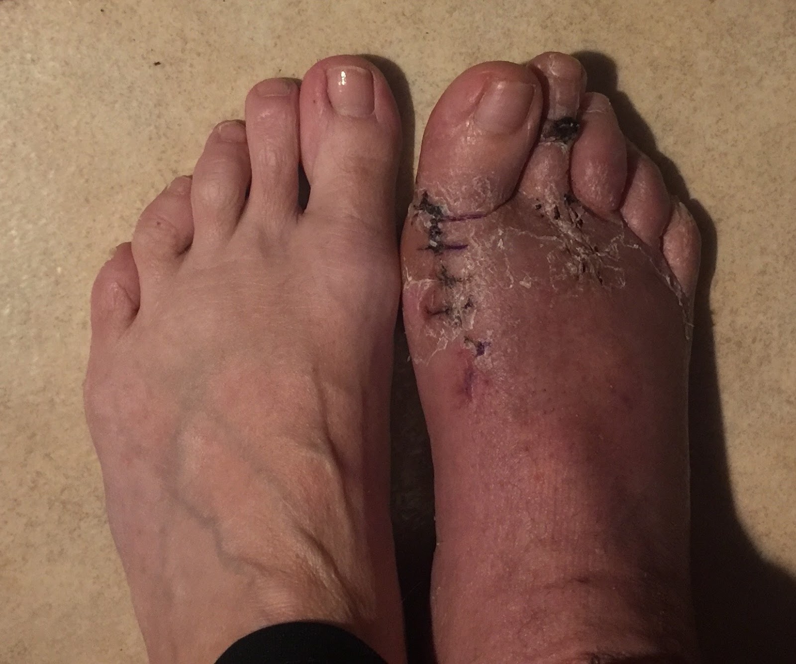 svullen fot efter knäoperation svullen fot efter knäoperation
