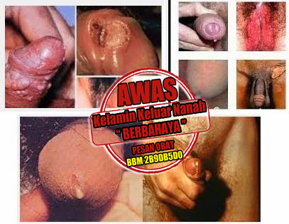Pengobatan Kelamin Keluar Nanah Dengan Herbal Pengobatan Kelamin Keluar Nanah Dengan Herbal