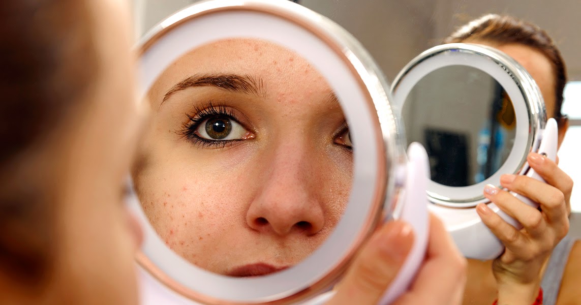 How To Take Care Of Pimples That Are Caused Due To Heat Family Health Articles