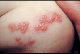 Foto Cara alternatif dan aman Menyembuhkan Herpes Yang Ampuh Sampai Tuntas