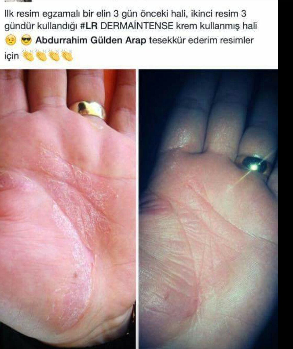 Ellerde egzama nasıl tedavi edilir Ellerde egzama nasıl tedavi edilir