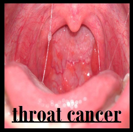 Throat Tumour 66