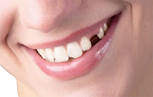 CẤY GHÉP IMPLANT PHỤC HÌNH RĂNG HÀM BỊ MẤT