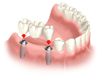 Răng Implant có gây hại cho cơ thể hay không ?