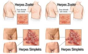 Ciri-ciri Penyakit Herpes Ciri-ciri Penyakit Herpes