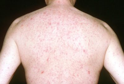 Pruritus or rash