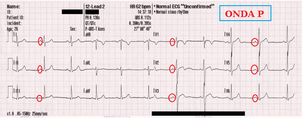 Electrocardiograma normal: onda P 