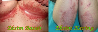 jual obat gatal eksim, Review Eksim Kering, Obat Herbal Untuk Penyakit Eksim Basah, Nak Hilangkan Gatal Di Kemaluan, salep untuk gatal gatal eksim, Jamu Obat Eksim, Pengobatan Penyakit gatal eksim Kering, Eksim Laser, Obat Penyakit Kulit gatal eksim Pada Bayi, Obat Eksim Hpai, Gambar Eksim Basah, Mengobati Gatal Di Kemaluan, Cara Mengobati Eksim Seboroik, gatal eksim Kering Dan gatal eksim Basah, Obat Eksim Kering Yg Mujarab, Eksim Basah, Obat Tradisional Mengatasi gatal eksim, Jual Obat gatal eksim Basah, Mengobati Eksim Pada Selangkangan, Mengobati Eksim Dengan Salep 88, Eksim Pada Kaki Bayi, Apakah Penyakit Eksim Bisa Sembuh, gatal eksim Di Bibir, Gatal Di Selangkangan Dan Cara Mengobatinya, Obat gatal eksim Saraf, Obat gatal eksim Basah Untuk Ibu Hamil, Obat Penyakit gatal eksim Herbal, Penyakit Kulit Eksim Obatnya 