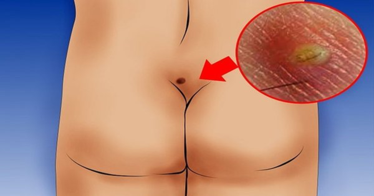 La tuberculosis de la columna vertebral los síntomas a los adultos el tratamiento