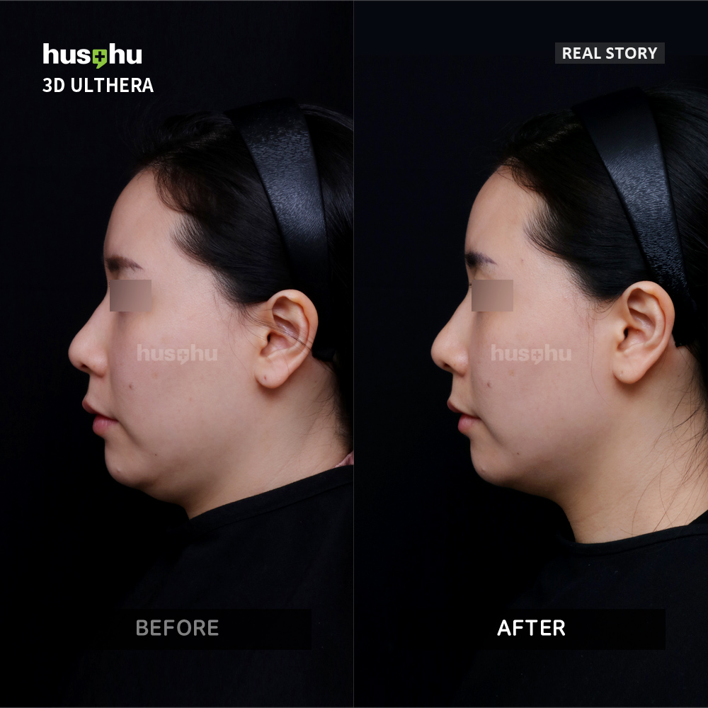 Hushu Dermatology Ultherapy Real Story hushu-dermatology-ultherapy-real-story