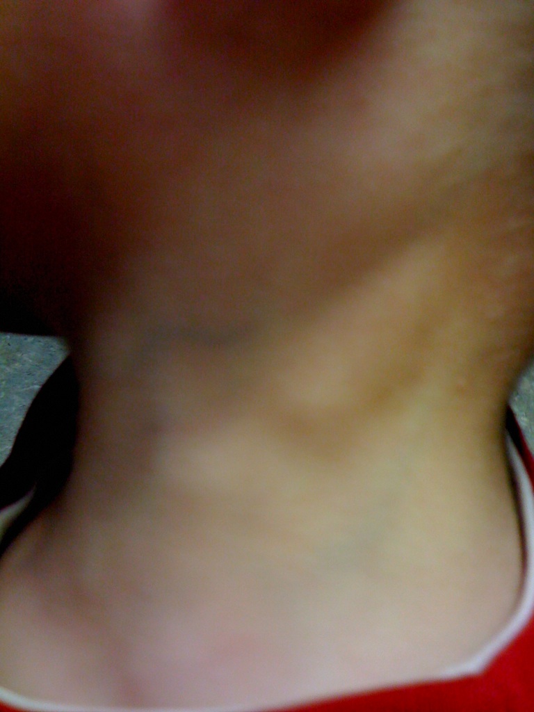 Bumps on neck? | Yahoo Answers