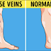 Garlic and Vinegar: Alisin ang Varicose Veins At Ibalik Sa Dating Normal Ang Inyong Ugat Gamit Ang Natural Na Paraan Na Ito