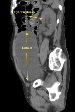 Urinary Retention ~ Ultrasound Cases Info