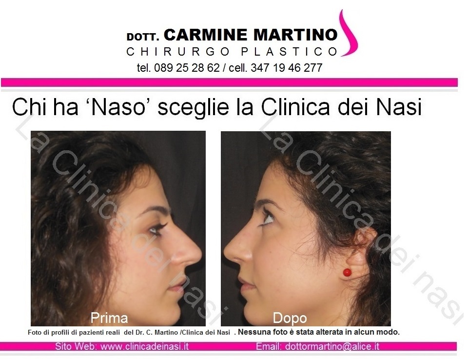 La Clinica Dei Nasi Dr Martino Salerno Rinoplastica Roma Dr Carmine Martino Chirurgo Plastico Specialista In Rinoplastica