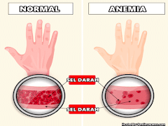3 Punca Utama Penyakit Kurang Darah Merah (Anemia)