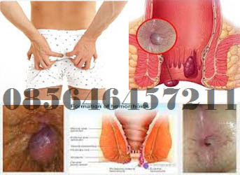 Info Sehat Hemorhoid (Wasir) AmbeJOSS De Nature