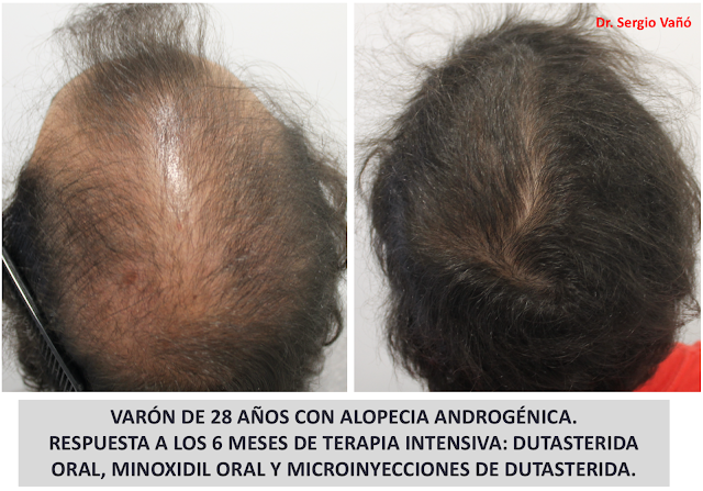 Dermatolog\u00edaMadrid: NUEVAS TERAPIAS EN ALOPECIA ANDROG\u00c9NICA Dermatolog\u00edaMadrid: NUEVAS TERAPIAS EN ALOPECIA ANDROG\u00c9NICA