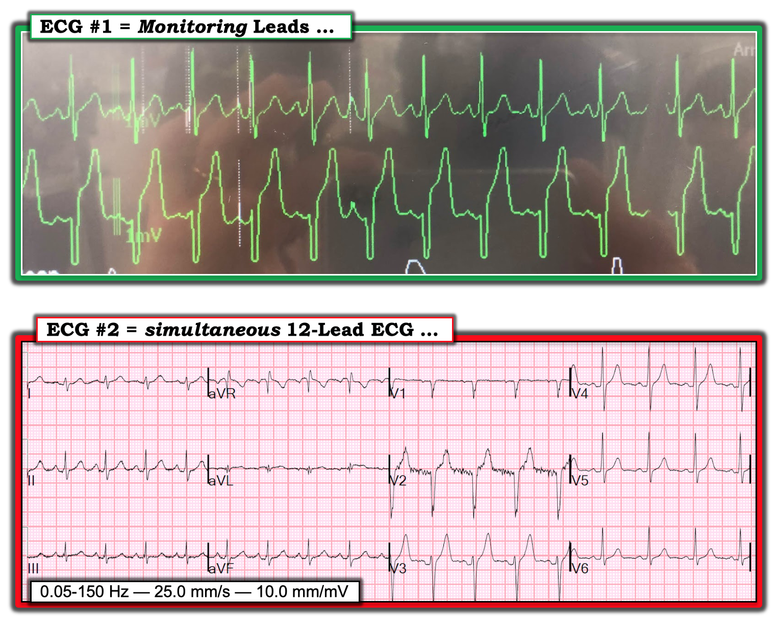 Dr. Smith's ECG Blog How accurate are the Monitor leads for ST Elevation?