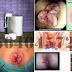 Wasir Internal & Eksternal dan Obatnya thumbnail