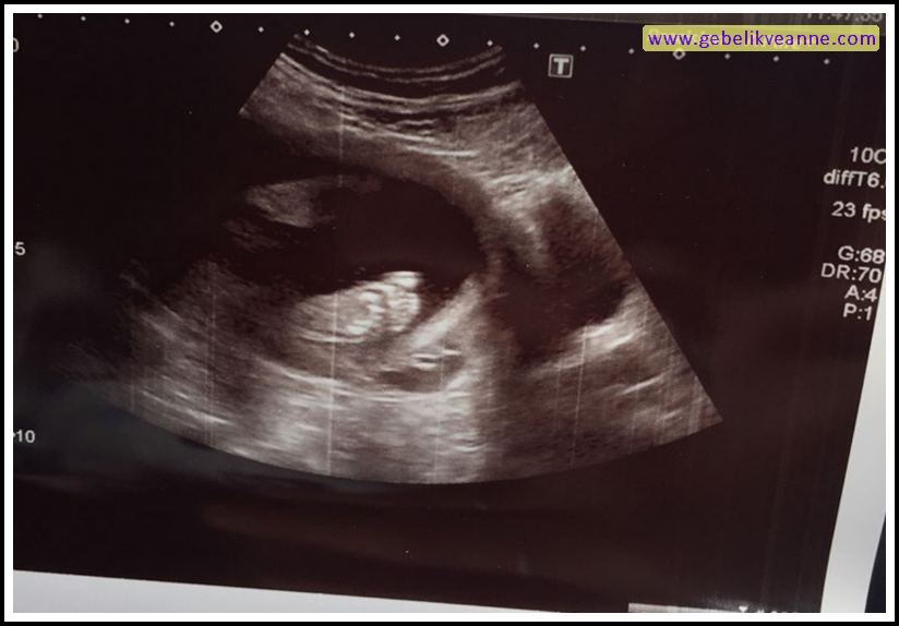 20 Haftalık Gebelik (Hamilelik) Ultrason Görüntüleri
