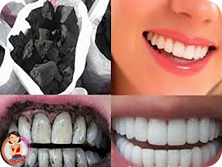 طرق استخدام الفحم لتبيض الاسنان