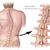 My Scoliosis Experience (Curving of the spine) | Story + Surgery + Tips