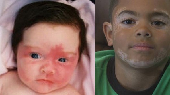 cara-menghilangkan-vitiligo-pada-anak cara-menghilangkan-vitiligo-pada-anak