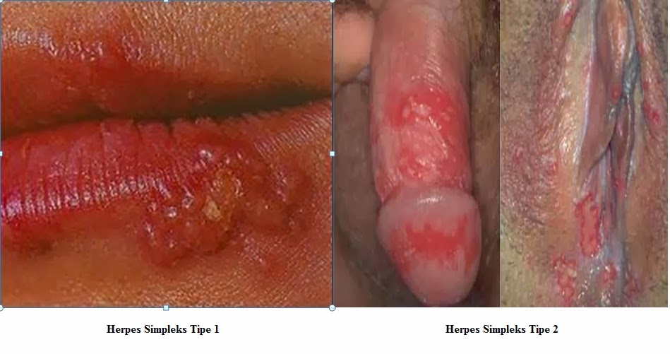 Bump or Ulcer in the Mouth - Fauquier ENT
