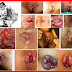 Cari Obat Anus Bengkak (Wasir) di Apotik thumbnail