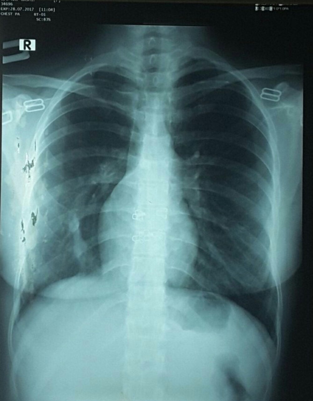 Mild chest (thorax)