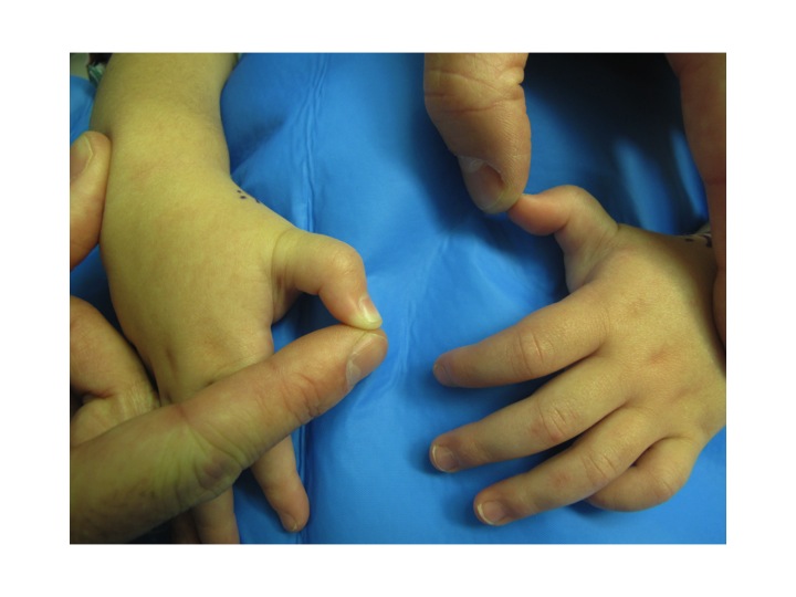 Recollect more cannot bend finger into fist opinion Pity, that cannot bend finger into fist