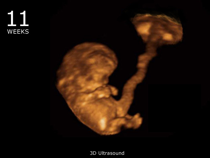 На 11 неделе тянет. 3д УЗИ 11 недель беременности. 11 Недель беременности фото плода. Эмбрион на 11 неделе беременности. Снимок 11 недель беременности.