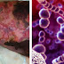 WARNING: Deadly Synthetic Flesh-Eating Bacteria Has Mutated, Spreading Like Wild Fire. Stay Alert!