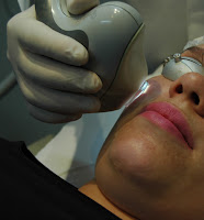 Vasinhos na face | Clínica Weiss | Hugo Weiss Dermatologia Vasinhos na face | Clínica Weiss | Hugo Weiss Dermatologia