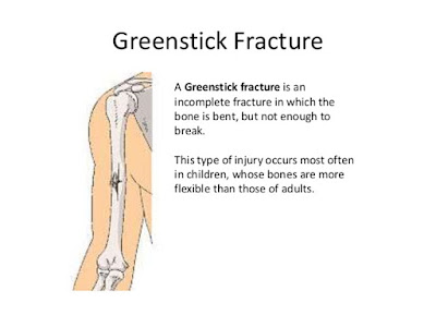 definition of Green stick fracture