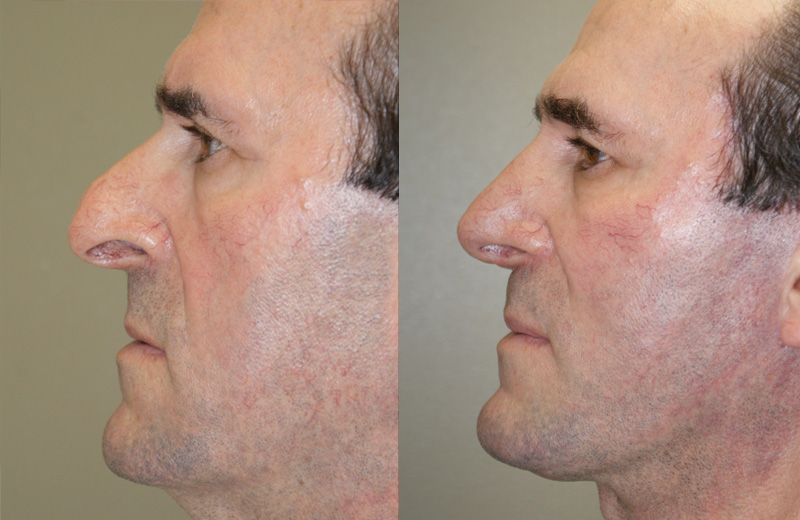 nose surgery cost Rhinoplasty Nose Surgery may be the Many Aesthetic