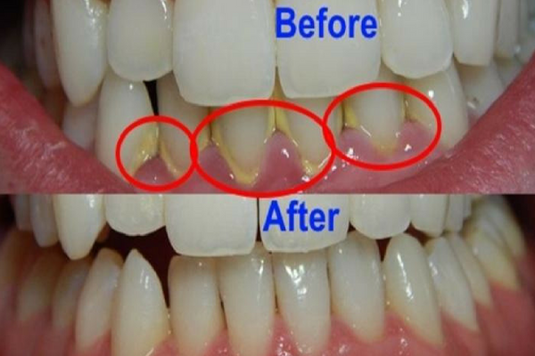 Mudah, Cepat dan Praktis, ini 7 Cara Menghilangkan Karang Gigi Secara Alami