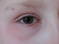 green eye sore white sclera