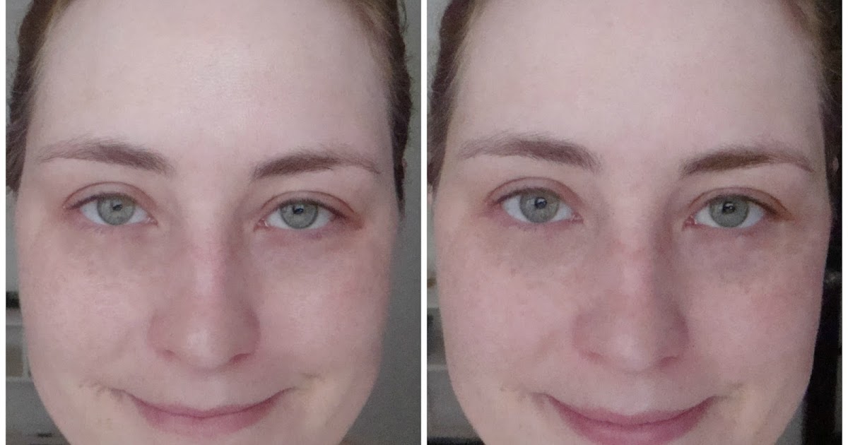 Mothlhtqqjbpqdp L'Oreal Revitalift Before And After