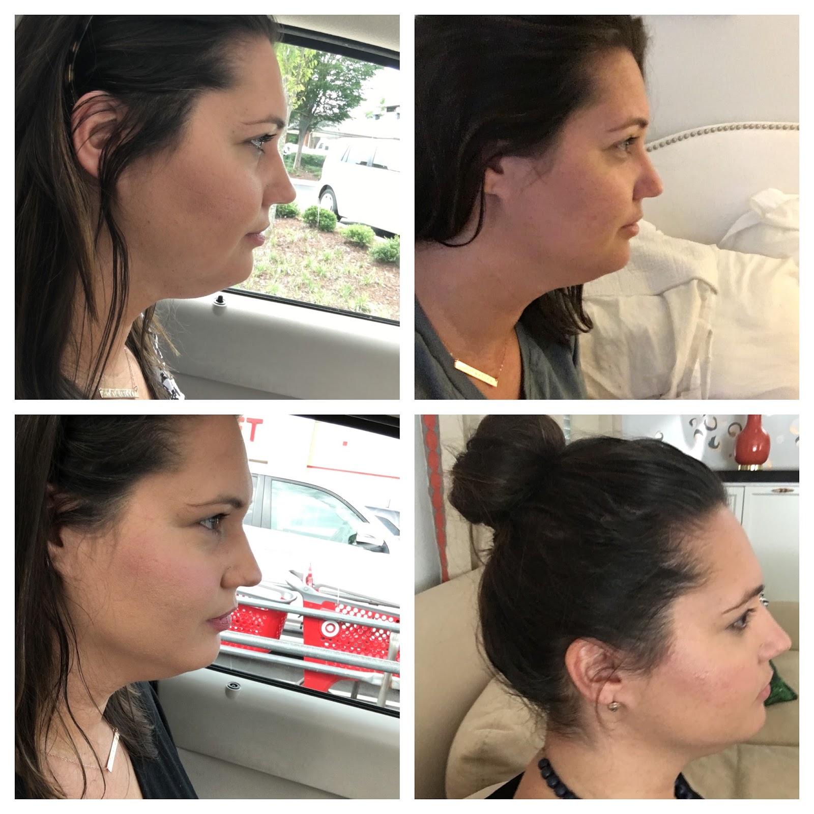 The Truth About Kybella Olive and Tate