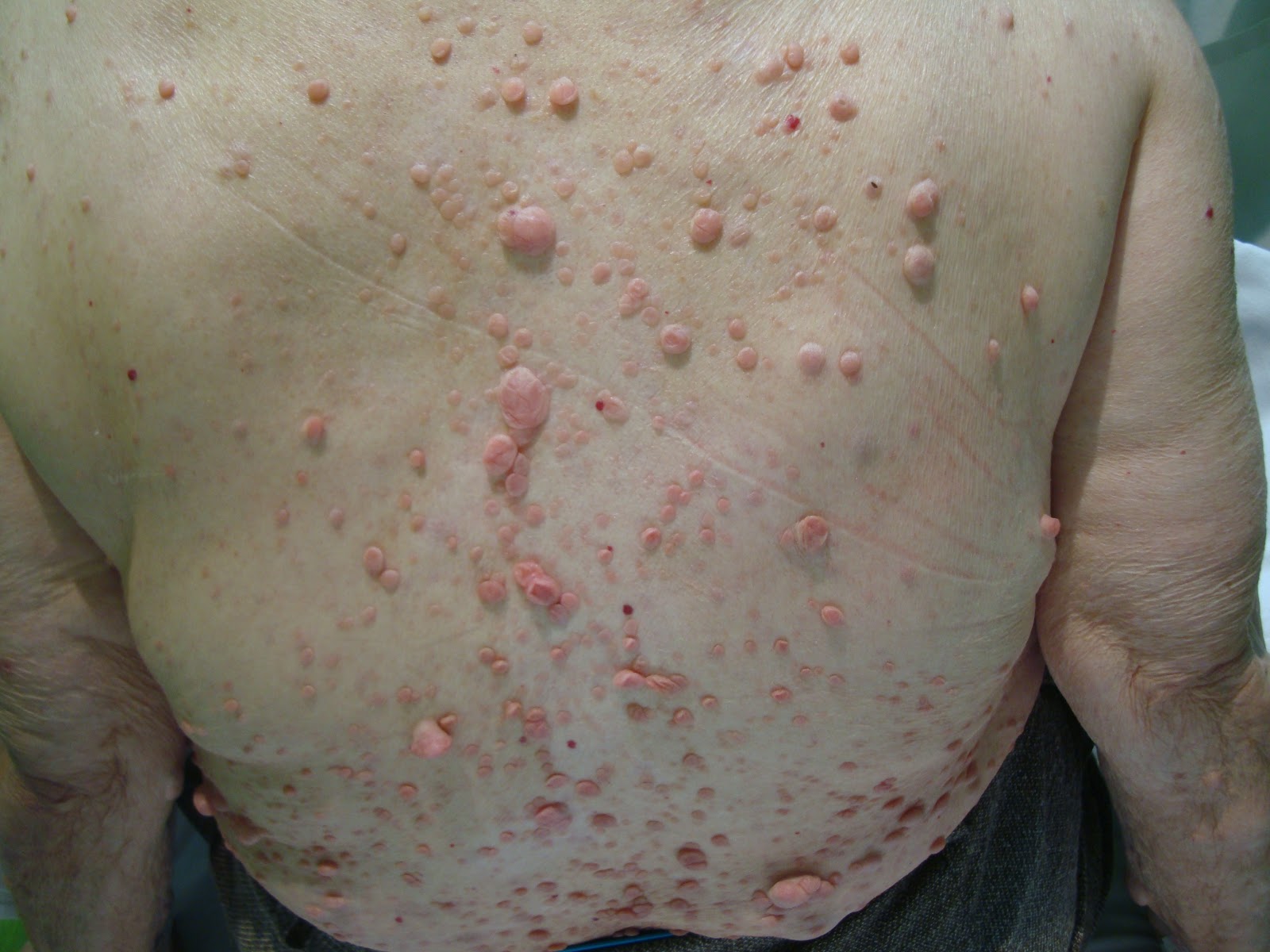 Simply Dermatology Neurofibromatosis Type 1