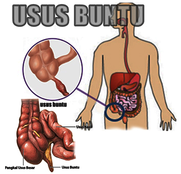 a medical illustration of the differences between gastric and small intestine symptoms of Usus Buntu