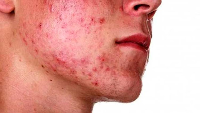 8 Home Remedies For Acne