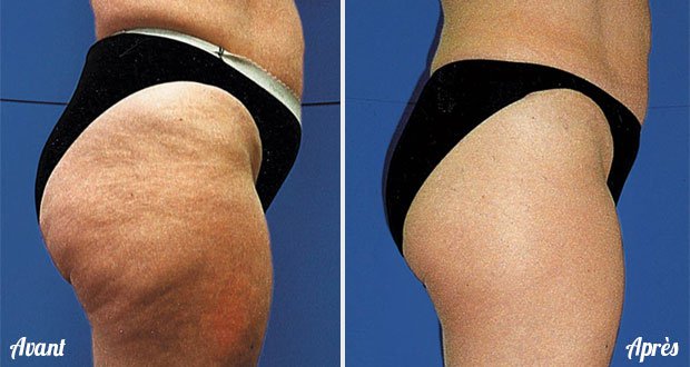 Vérité Et Contre Vérité Sur La Cellulite Vérité Et Contre Vérité Sur La Cellulite