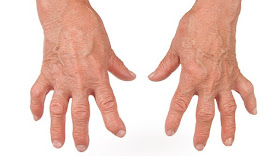 La artrosis no sólo es de gente mayor