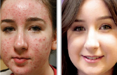 Acne Treatment Cost Acne Treatment Cost
